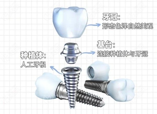种植牙优势236z.com