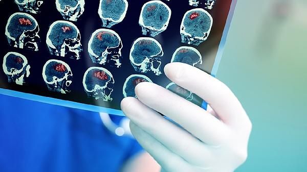 慢跑是腦梗的“隱藏元兇”？告誡：想腦血管健康，這3件事要避免