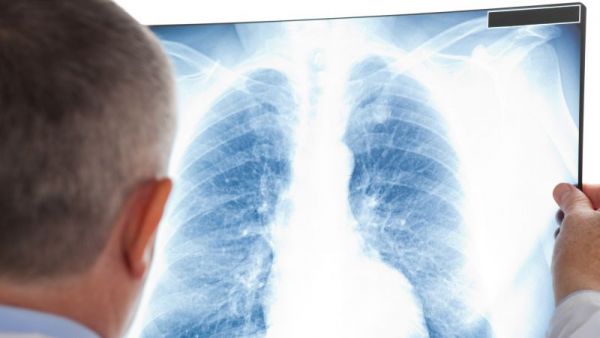 肺磨玻璃影是常見(jiàn)病嗎