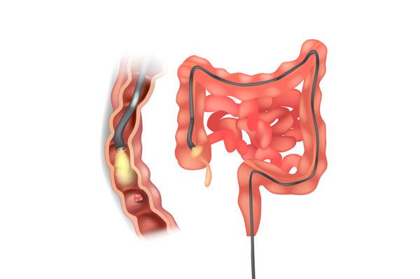6種癥狀需做腸鏡檢查腹部不適
