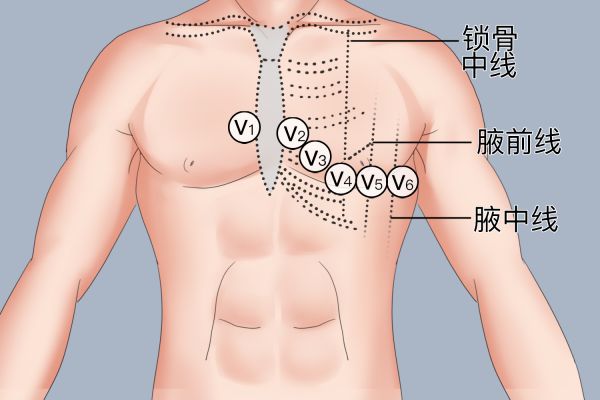 V1-V6导联连接图