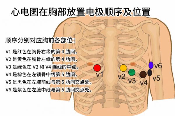 胸前导联有V1-V6六个电极位置
