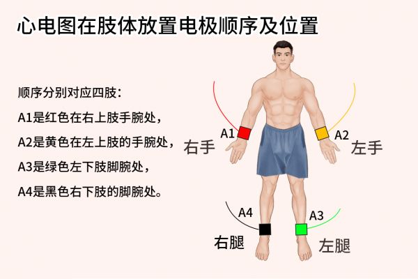 肢体导联电极A1-A4位置