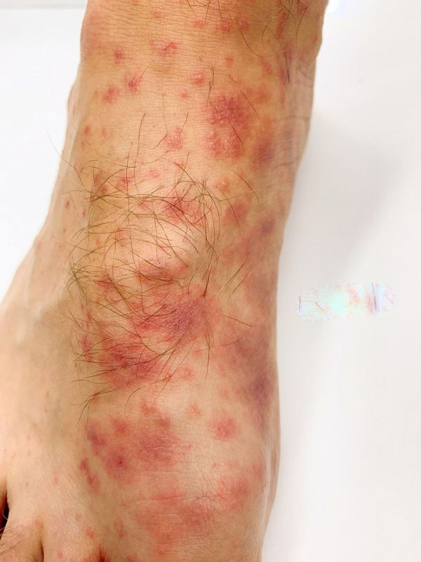 两腿上起了好多红疙瘩很痒