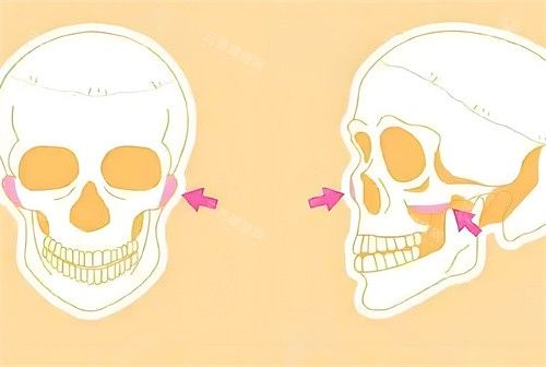 颧骨手术磨骨部位骨头演示动画图