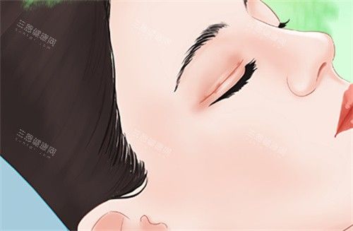 需要雙眼皮修復的眼睛