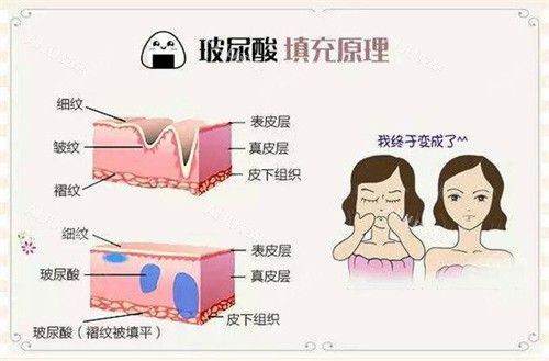 玻尿酸注射填充原理動畫演示圖