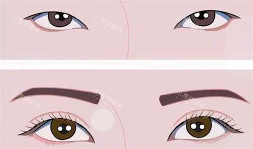 双眼皮前后对比