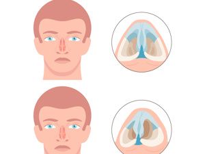 北京做隆鼻好的整形医院排名前十：整形、医院、米扬丽格，擅长鼻综合、鼻修复、肋软骨/耳软骨/假体隆鼻