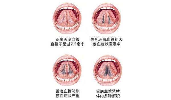 “舌下青筋”，可看身体状况！这种情况警惕→