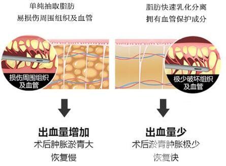 背部吸脂瘦身术原理
