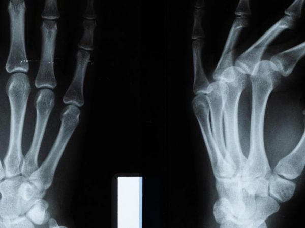手腕天天加班？四步预防疼痛远离腕管综合征