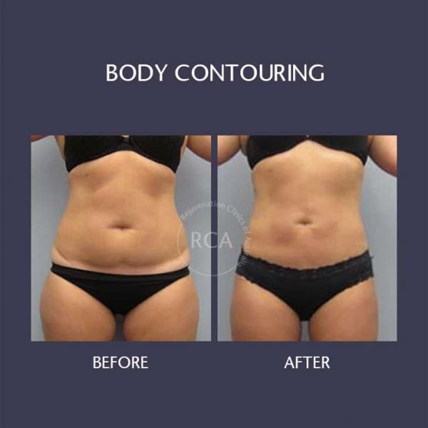 Fat Reduction Results female Before After Body Contouring Fat Freezing