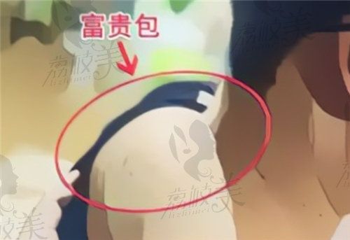 富贵包乳化微创挂什么科比较好