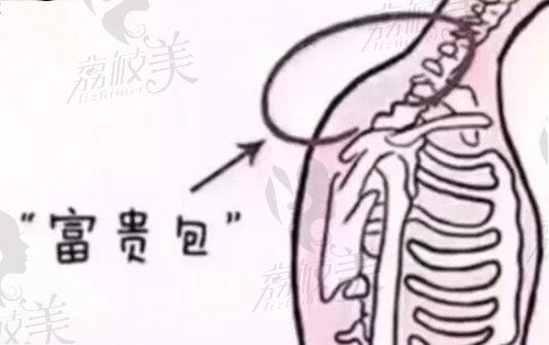富贵包乳化微创成效怎么样