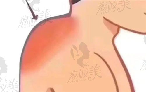 微创乳化富贵包哪里好