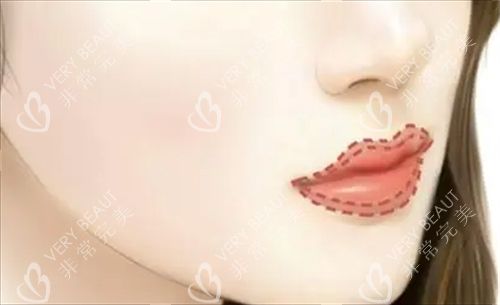 丰唇唇部画线填充图
