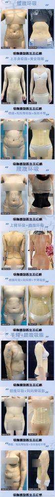 成都军大蒲小兵医生：大吸脂量+细节雕刻，狠劲与安心并存