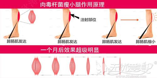 打瘦腿瘦小腿的原理