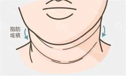 因脂肪堆積產(chǎn)生頸紋