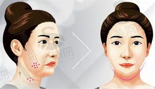 面部埋線可以讓臉變小嗎？