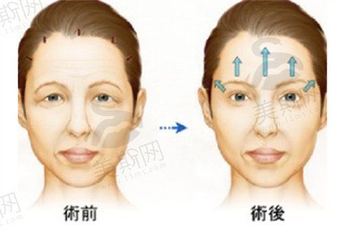 面部提升手術(shù)用哪一種方法比較好？
