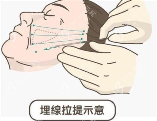 埋線提升面部的操作過程