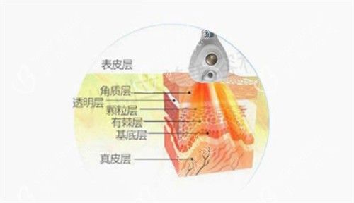 溶脂刀儀器可以深入到的層次圖解
