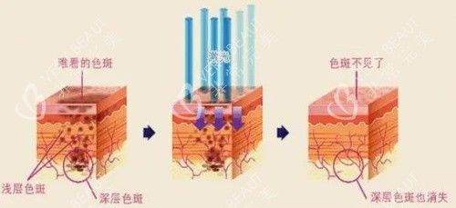 激光祛斑治疗示意图