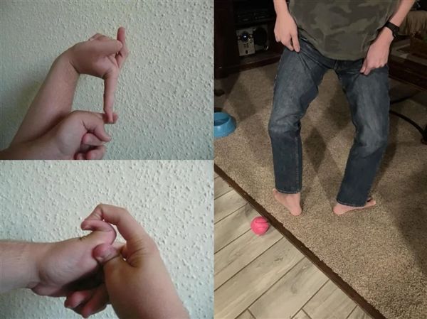 英国男子皮肤Q弹破纪录：脖子皮肤一拉可当口罩戴