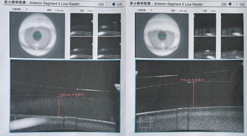 千里赴深！云南袁女士告別 1100 度近視，術(shù)后首日視力達 1.2