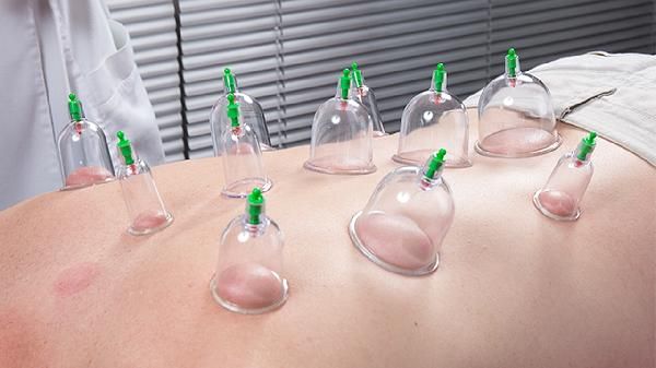 中醫(yī)拔罐減肥原理