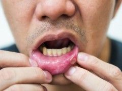 為什么口腔潰瘍發(fā)病時伴有便秘和口臭？患有口腔潰瘍不妨吃這些