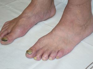 足浴盆有灰指甲怎么清洗