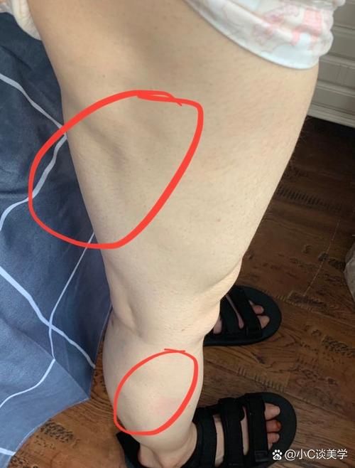 吸脂減肥有什么風(fēng)險