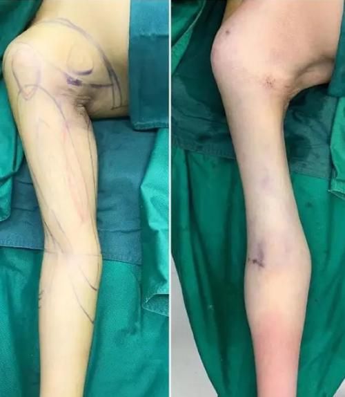 吸脂減肥有什么風(fēng)險