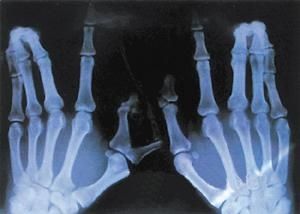 【科普】維生素 D 到底要不要補？