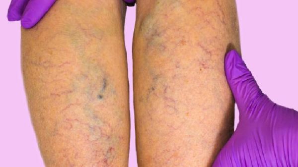 怎样判断是否是水肿型肥胖 水肿型肥胖有哪些减肥方法