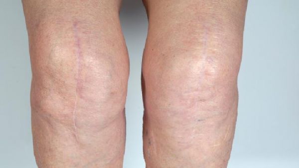 水腫型肥胖怎么減肥？如何快速去除水腫？