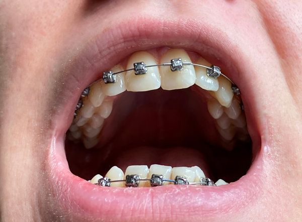 矯正牙齒對(duì)身體有影響嗎