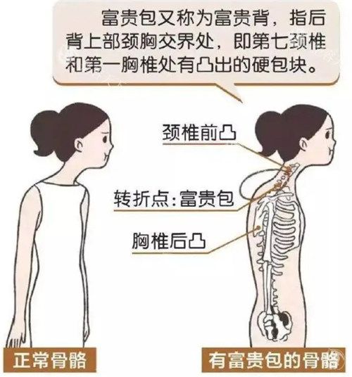 正常骨骼跟有富贵包的骨骼