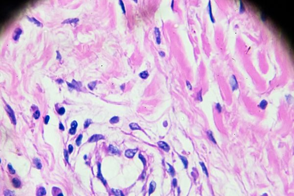 胰島素抵抗怎么減肥 特殊情況下的減重策略