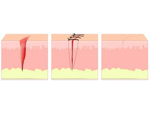 順產(chǎn)傷口撕裂怎樣護理？