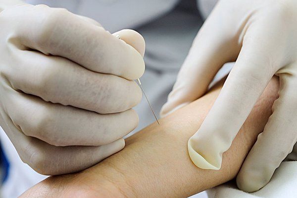 北京推拿针灸减肥和埋线