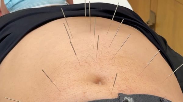 北京中醫(yī)醫(yī)院多種減重方式等你來(lái)打卡！