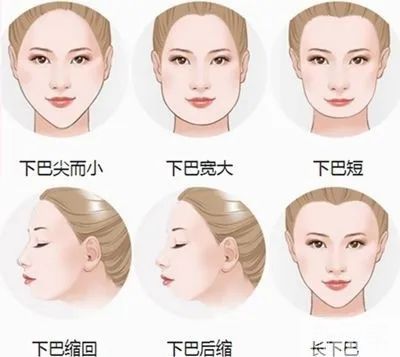 【醫(yī)美小科普】改善面部輪廓從下巴開始 圖片-2