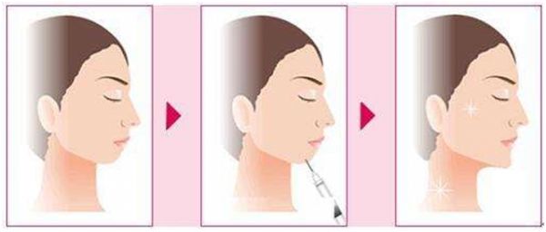 【醫(yī)美小科普】改善面部輪廓從下巴開始 圖片-4