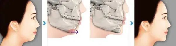 【醫(yī)美小科普】改善面部輪廓從下巴開始 圖片-6