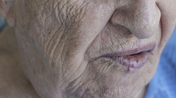 皮膚松弛治療方法