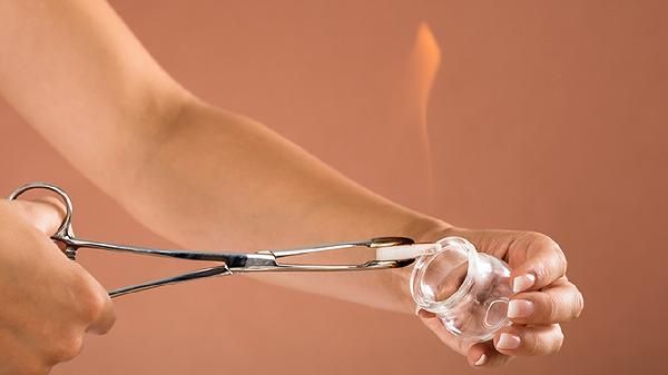 健康人拔罐有什么好處